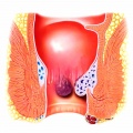 Antihemorrhoidal